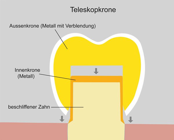 Illustration einer Teleskopkrone